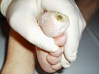 ಅಂಗಾಂಗ ಊನವಾದರೆ ಡಯಾಬಿಟಿಸ್ ಕಾರಣವೇ?