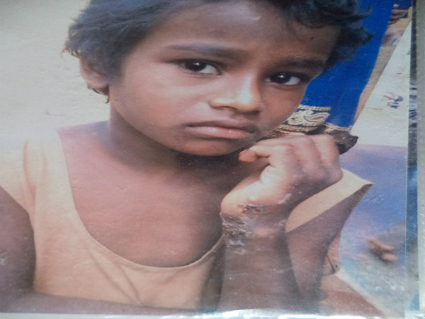 ನಾನಾ ರೋಗಗಳ ತವರಾಗುತ್ತಿರುವ ಆಶ್ರಮ ಶಾಲೆ