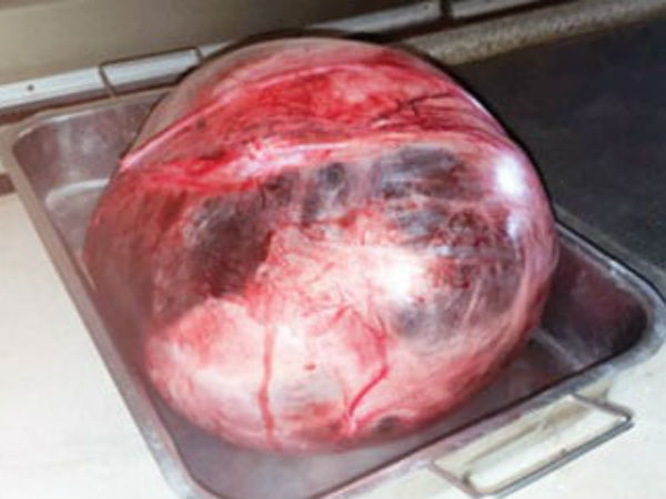 12 kg tumor in woman stomach operated by Mysuru doctors 12 kg tumor in woman stomach operated by Mysuru doctors