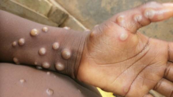 Americans are very much feared about Monkeypox Virus Americans are very much feared about Monkeypox Virus