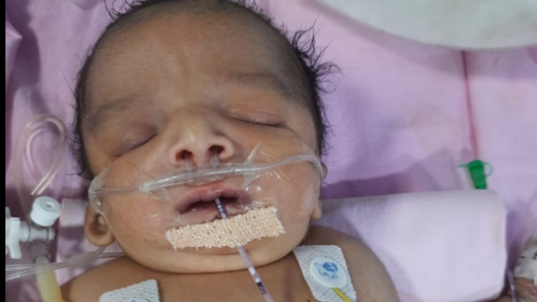 Help 6 Month Old Baby Affected With Treacher Collins Syndrome Help 6 Month Old Baby Affected With Treacher Collins Syndrome