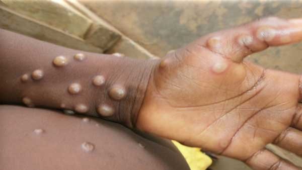 ರೋಗಲಕ್ಷಣಗಳೇನು?