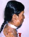 and Now (after acid attack)