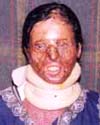 and Now (after acid attack)